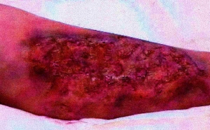 brulure